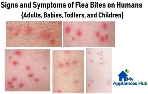 Flea Bites on Humans: What Do Fleabites Symptoms Really Look Like?