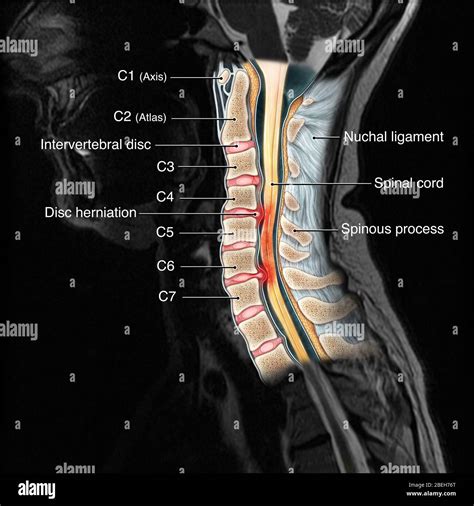 Cervical Spine Injury, MRI Stock Photo - Alamy