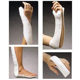 Orthoglass splint examples - ALiEM