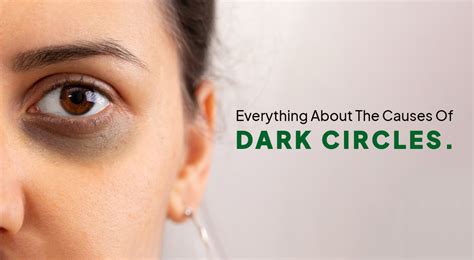 Everything About The Causes Of Dark Circles - Anherb – Anherb Natural