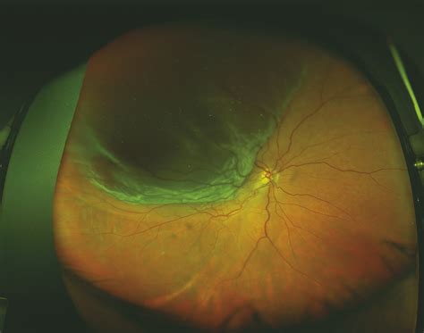 Primary Rhegmatogenous Retinal Detachment | Ento Key