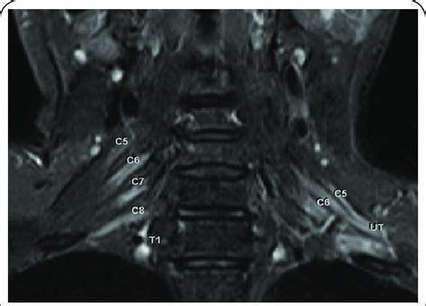 Brachial Plexus Mri Anatomy / Presentation2 Radiological Imaging Of ...