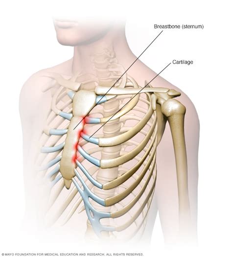 Costochondritis - Symptoms and causes - Mayo Clinic