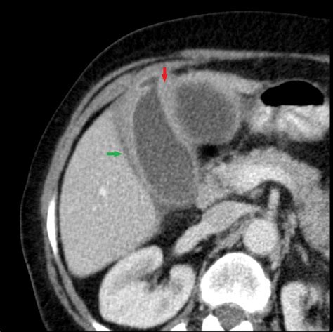 Gallbladder perforation - radiological aspects, types and causes ...