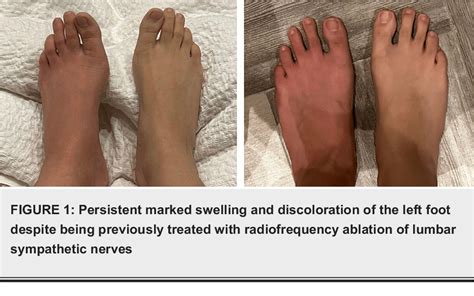 Figure 1 from An Unusual Presentation of Complex Regional Pain Syndrome ...