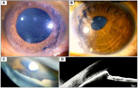 Peripheral Anterior Synechiae as a Manifestation of Axenfeld-Rieger ...