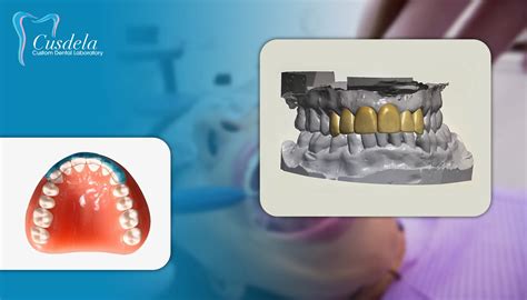 What is diagnostic wax-up? - Blog