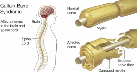 Guillain-Barré Syndrome(GBS): Causes, Symptoms, Diagnosis & Treatment ...