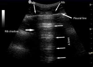 POCUS Lung – Introduction to A-lines and B-lines | Point-of-Care ...