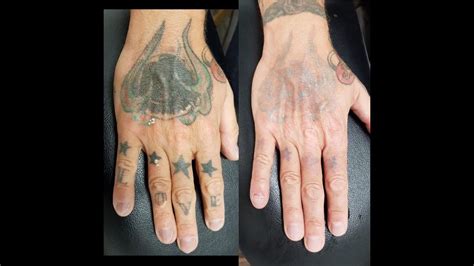 dermabrasion tattoo removal before and after - Marcene Oconnell