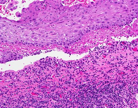 Mucous Membrane Pemphigoid Histology