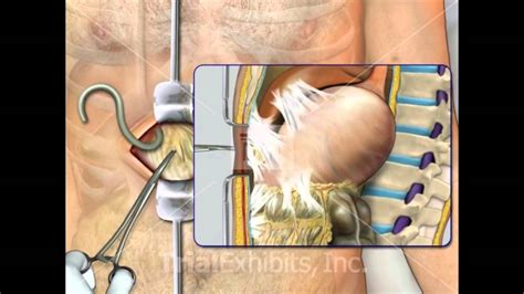 Ventriculoperitoneal Shunt Complications - Medical Animation - YouTube