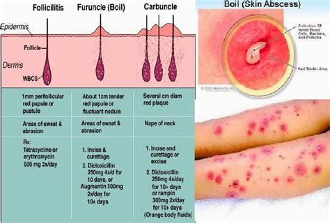 TREATMENT FOR BOILS - by Dr. Tsan at Philadelphia Homeopathic Clinic