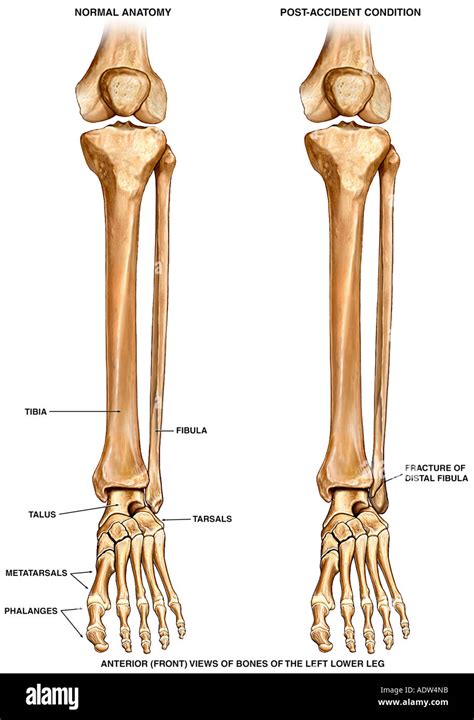 Ankle Lateral Malleolus Fracture