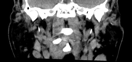 Normal CT sialogram | Image | Radiopaedia.org