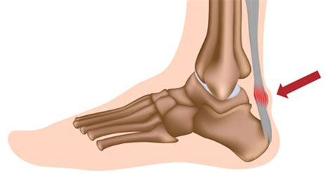 Achilles Bursitis | Retrocalcaneal Bursitis - Symptoms, Causes & Treatment