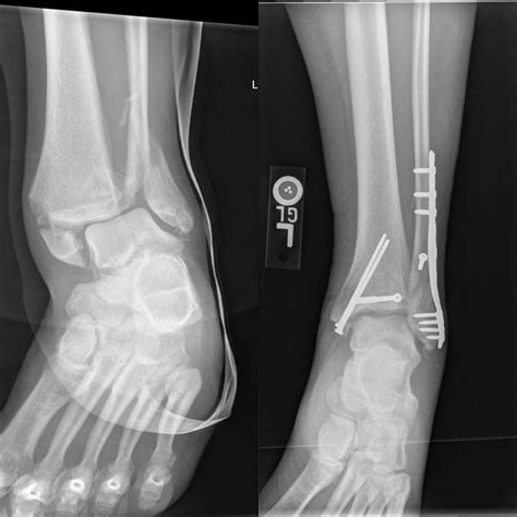 Ankle Fracture X Ray