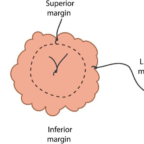 The mastectomy specimen margins are marked superior and lateral with ...