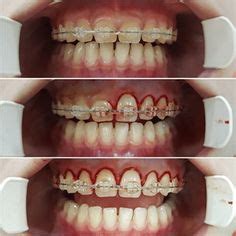 160 ORTHO ADS ideas | dental braces, teeth braces, braces colors