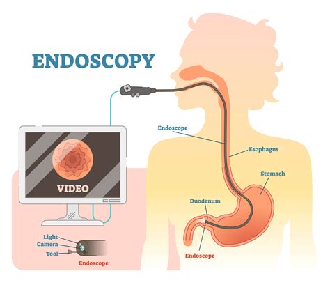 Gastroscopy | Christina Ong- Paediatric & Gastroenterology Clinic