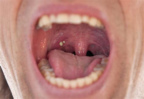 Are Troublesome Tonsil Stones Causing Your Bad Breath? – Health ...