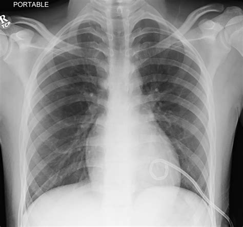 Where’s the air? Pneumothorax | Radiology Key