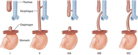 Esophageal atresia & tracheoesophageal fistula causes, symptoms & treatment