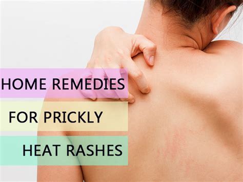 11 Effective Home Remedies For Heat Rash (Prickly Heat) - Boldsky.com