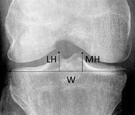 SAT0435 Tibial Spine Morphology and Association with Anterior Cruciate ...