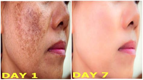 How to Remove Pigmentation, Blemishes , Dark Spots from Face ...