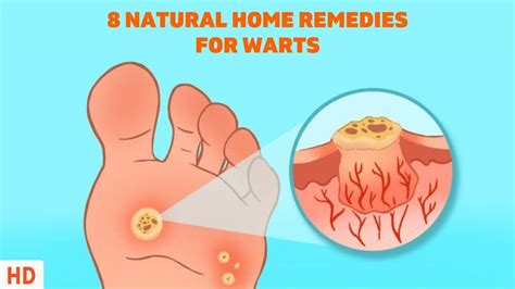 8 Surprising Home Remedies for Warts - Get Rid of Them Naturally! - YouTube