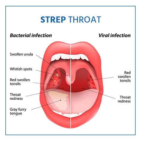 Strep No Fever