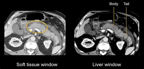 Abdominal CT: necrotizing pancreatitis • LITFL • Radiology Library