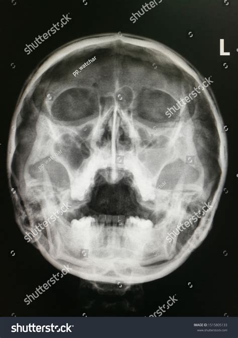 Xray Image Shows Both Maxillary Sinusitis Stock Photo (Edit Now ...