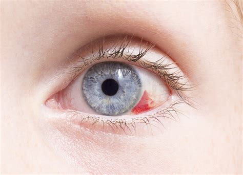 Scratched Eye Symptoms and Treatment - Diamond Vision