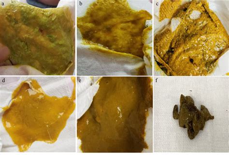 Stool characteristics during treatment. a Viscous stool after the first ...