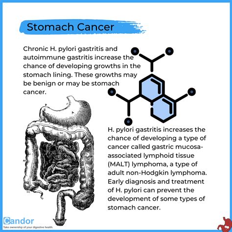 What are the Complications of Gastritis and Gastropathy? - Candor