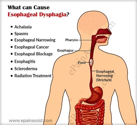 The causes of esophageal dysphagia. in 2020 | Dysphagia, Dysphagia ...