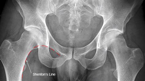 Hip X-ray Interpretation - OSCE Guide | Geeky Medics