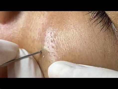 Amazing Pimple Popping Video - Pop That Zit - Since 2006!