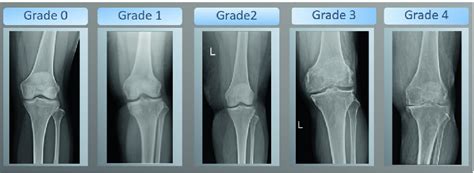 STAGES OF OSTEOARTHRITIS - Ashburn Physical Therapy, LLC