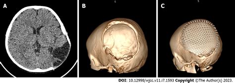 Spontaneous fracture of a titanium mesh cranioplasty implant in a child ...