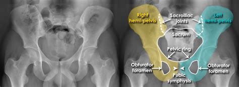 Trauma X-ray - Axial skeleton - Sacrum and Pelvis