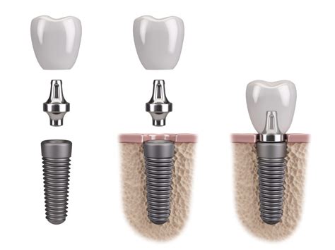 Your Guide To Dental Implant Basics - Dentalopolis Implant Dentistry