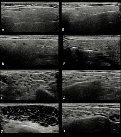 Frontiers | Salivary Gland Ultrasonography in Sjögren's Syndrome: A ...