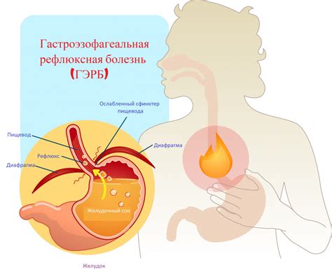 Síntomas de dispepsia intestinal, síndrome de dispepsia intestinal