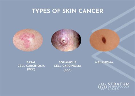 What are the common types of skin cancer? - Stratum Clinics