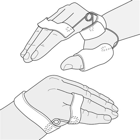 Ulnar Nerve Injury Splint