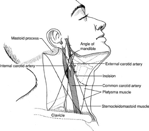 Carotid Endarterectomy | Basicmedical Key