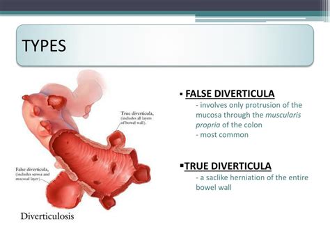 False Diverticulum